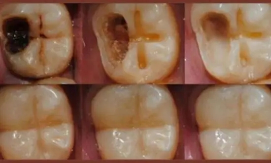 দাঁতের গ’র্ত কেন হয়, আর গ’র্ত হলে আপনি কী করবেন, জেনে নিন